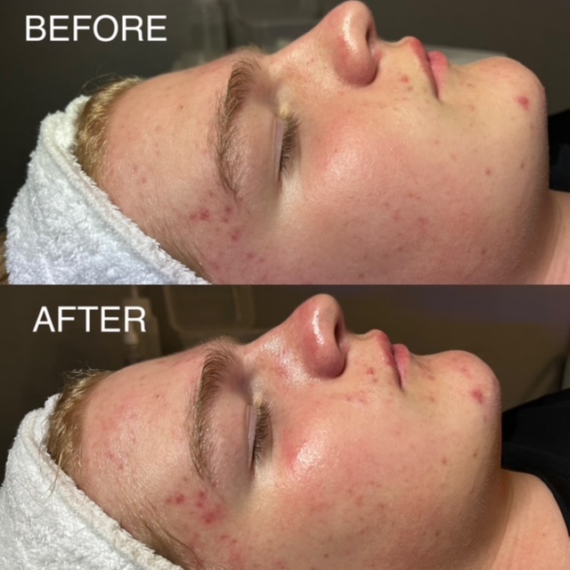 Teen Facial 45 min at BK Skin & Brow Co. in Saint Charles, IL