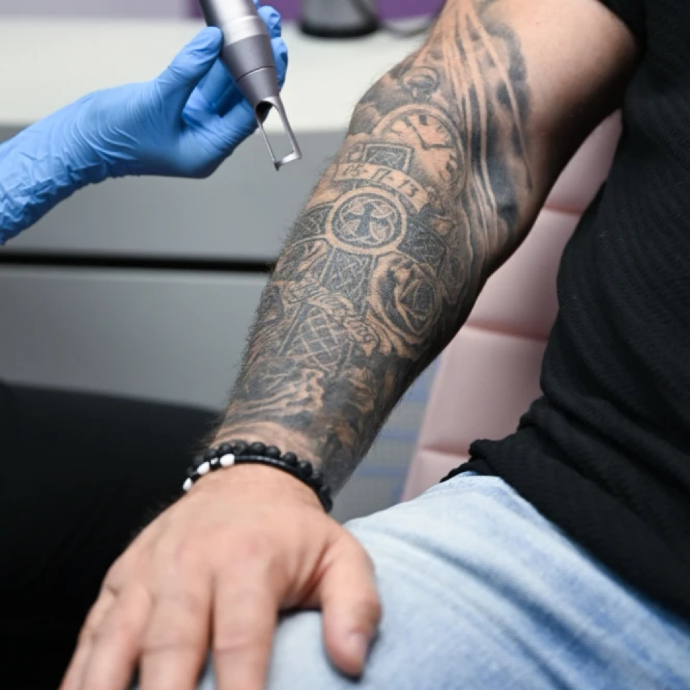 Tattoo Removal at Acnessia Laser Clinic in Guaynabo, PR