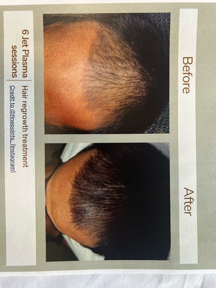 Hair Growth Treatment- Series Of 8