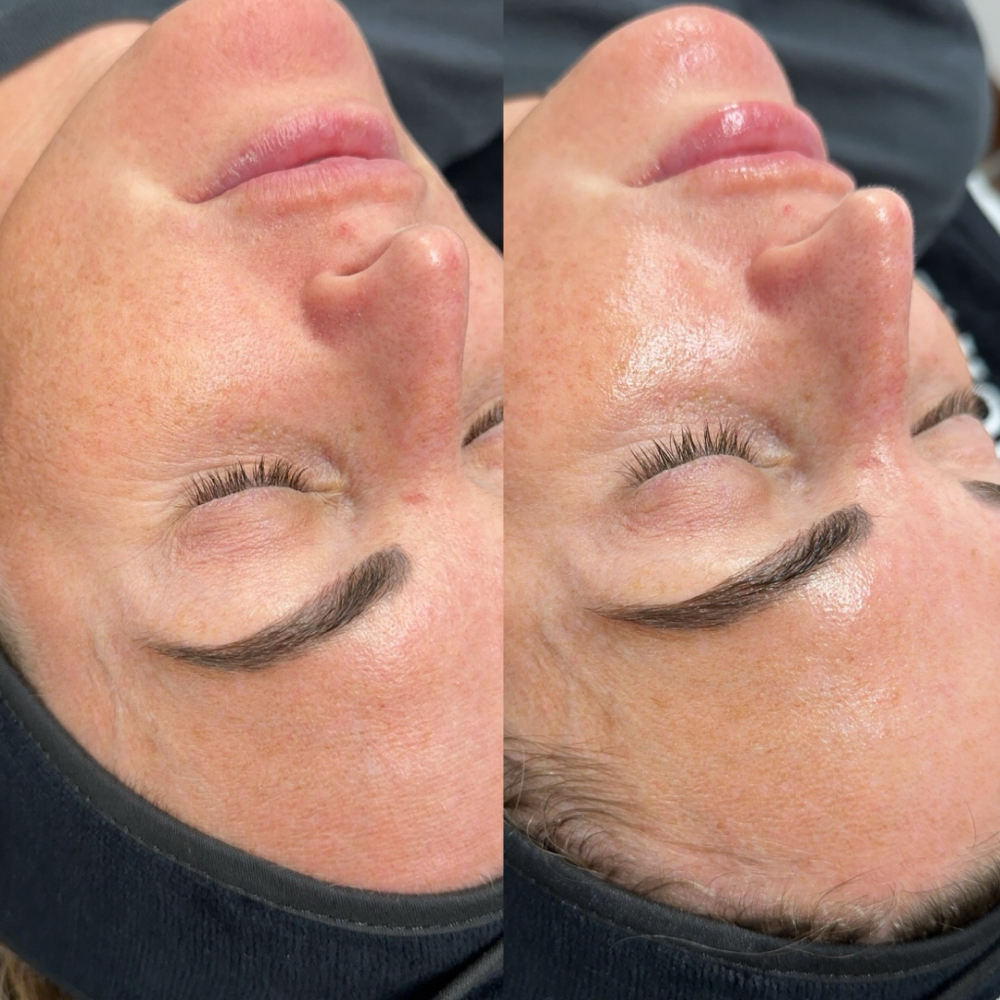 Glo2Facial