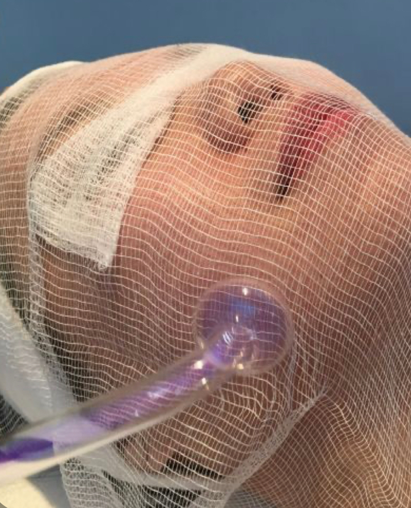 Limpieza Facial con alta frecuencia