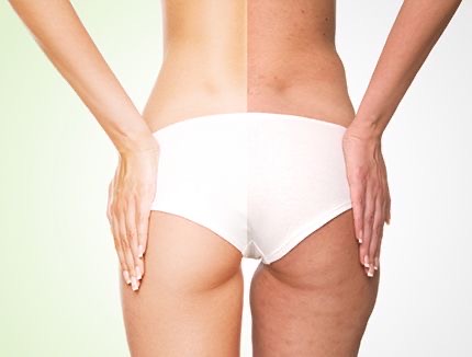 Cellulite Treatment