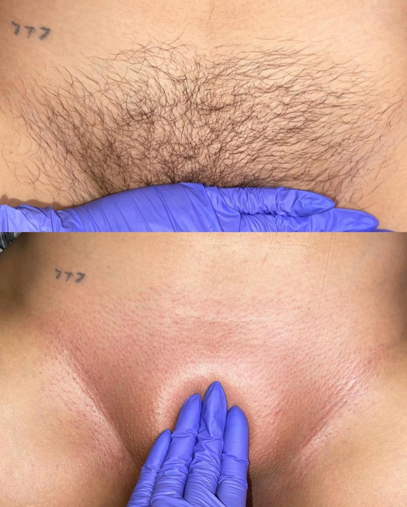 ★ #1 iconic fav: Brazilian Wax