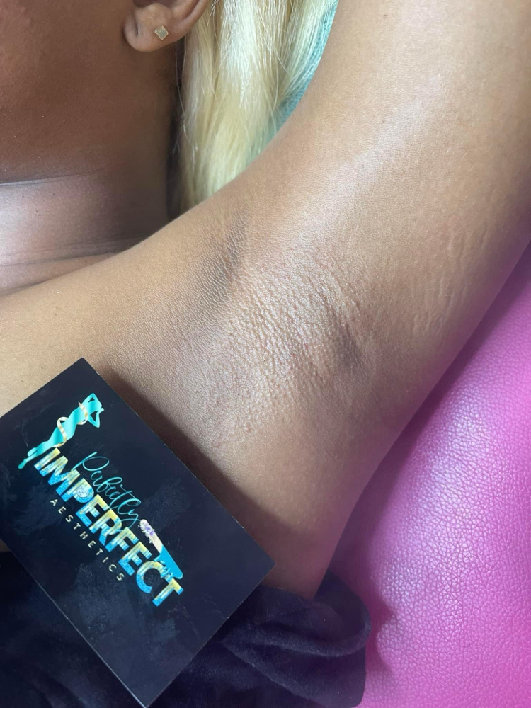 Underarm & Intimate Peel