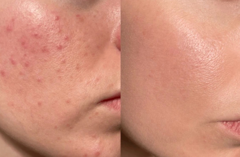 Acne Clearing Facial