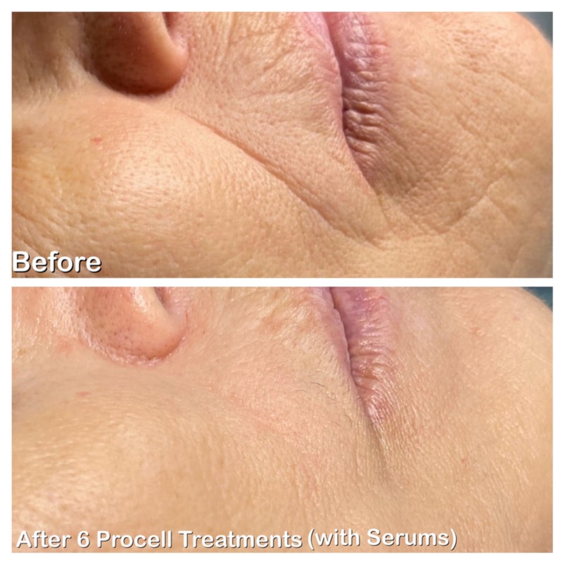 SCAR REVISION SESSION [SMALL SCARS] at GloVolution LLC in Homosassa, FL