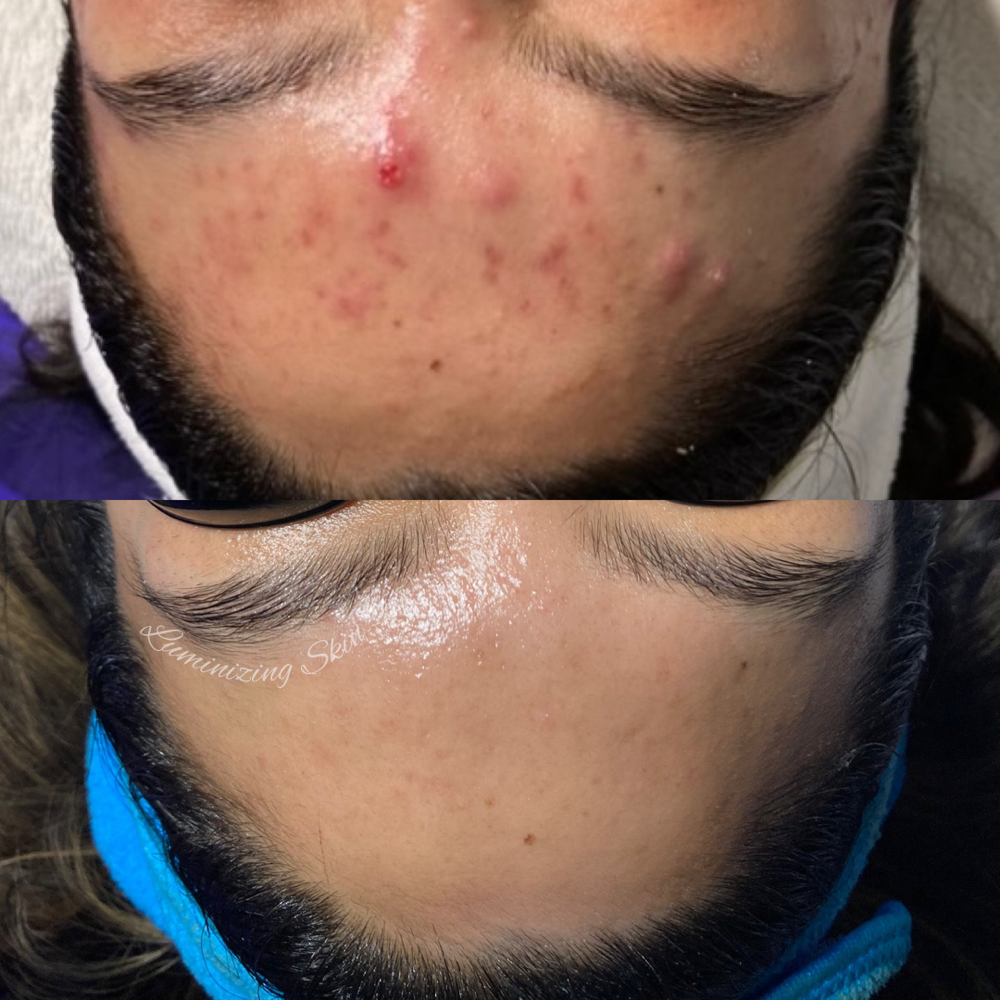 Mini Acne Treatment
