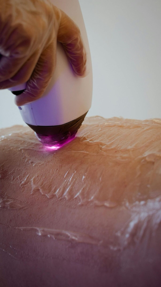 LASER Espalda Baja/ Lower Back at YubyRo in San Juan, PR