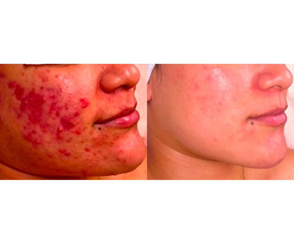Advanced Acne Treatment