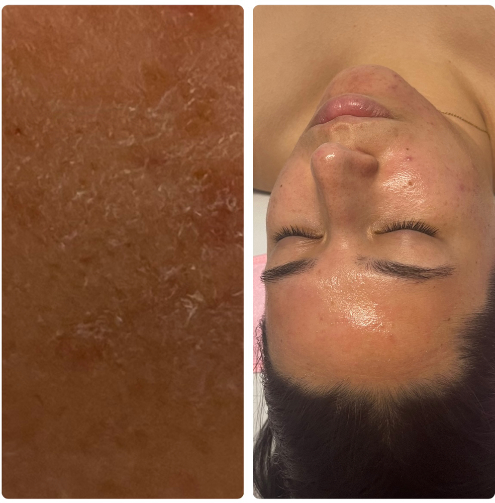 Acne/ Scarring Microdermabrasion