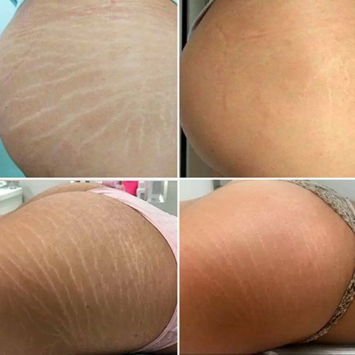 Stretch Mark Revision at Meraki Artistry in Greenwood, IN