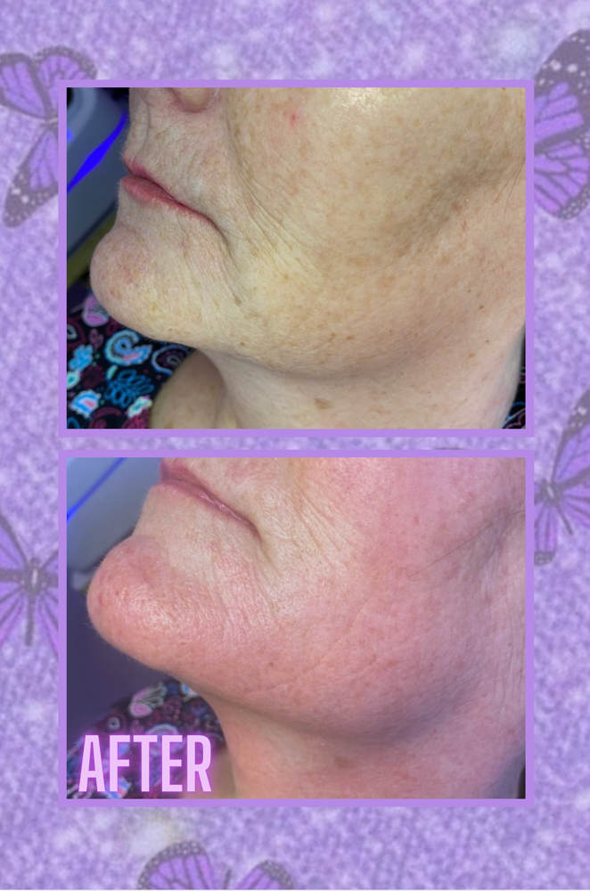 Chin Sculpting