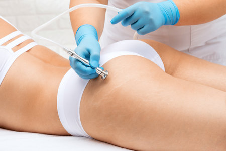 Microderm Body Treatment