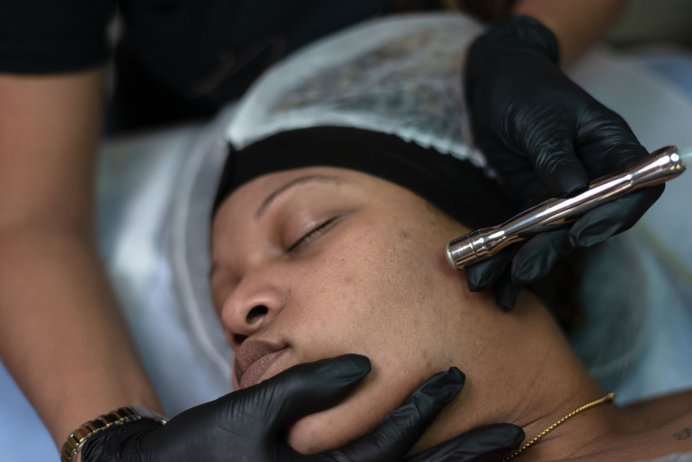 Microdermabrasion