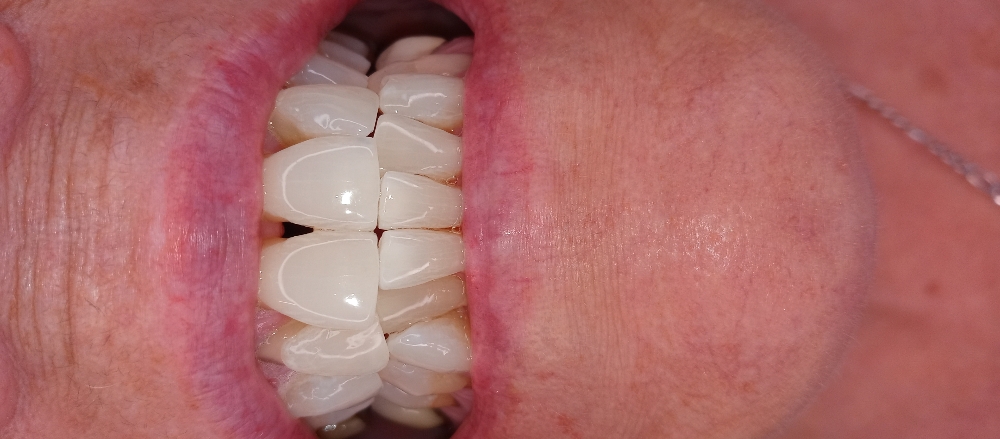 Teeth Whitening