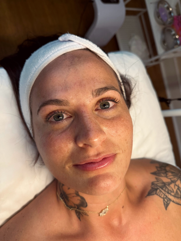 Acne Clearing at Ali Lanelle Esthetics in summerville, SC
