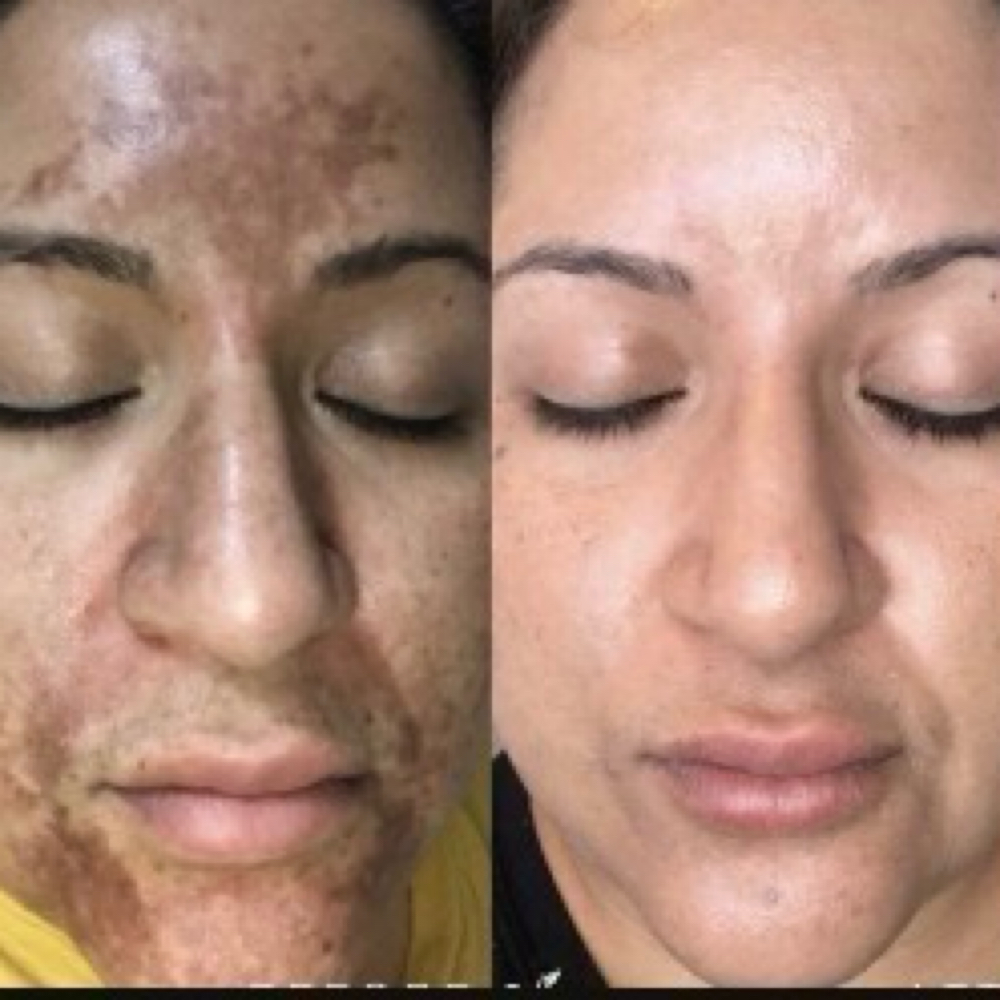 Chemical Peel 40% (add-on) at Sachi Nails and Body Spa in Yonkers, NY
