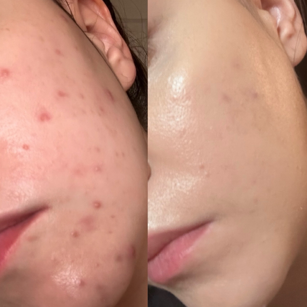 Acne Reset Treatment at MySkin Aesthetics in Laredo, TX