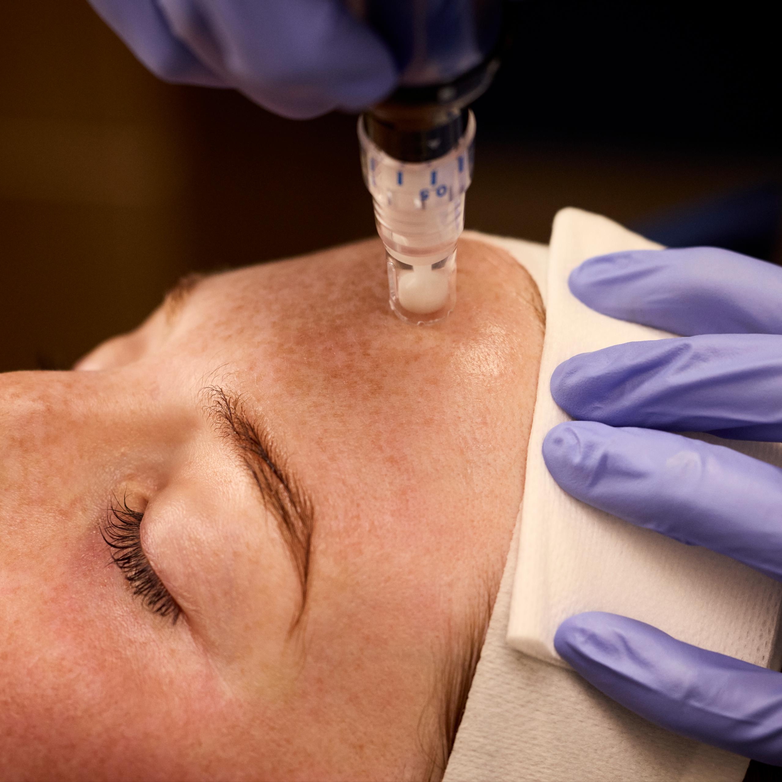 SkinPen Microneedling at The Glow Lab Aesthetics in Westbrook, ME
