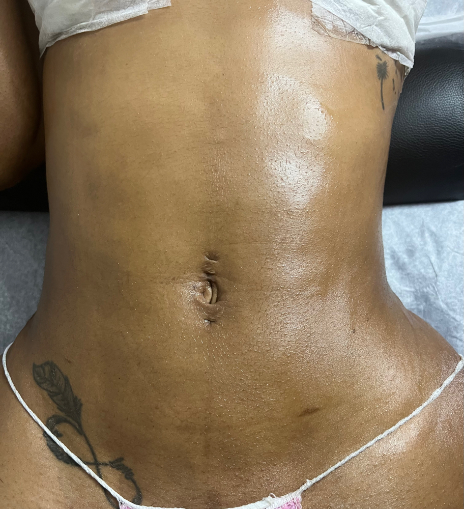 10 sessions Post-op