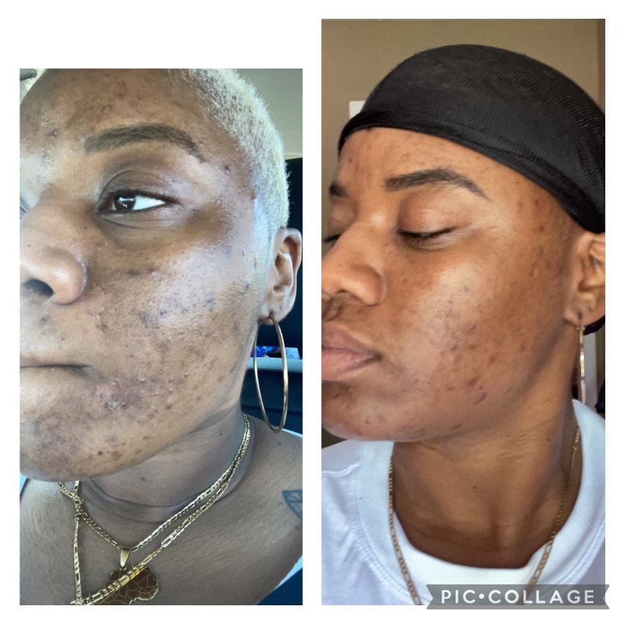 Enzyme Plant Peel-Sensitive Skin