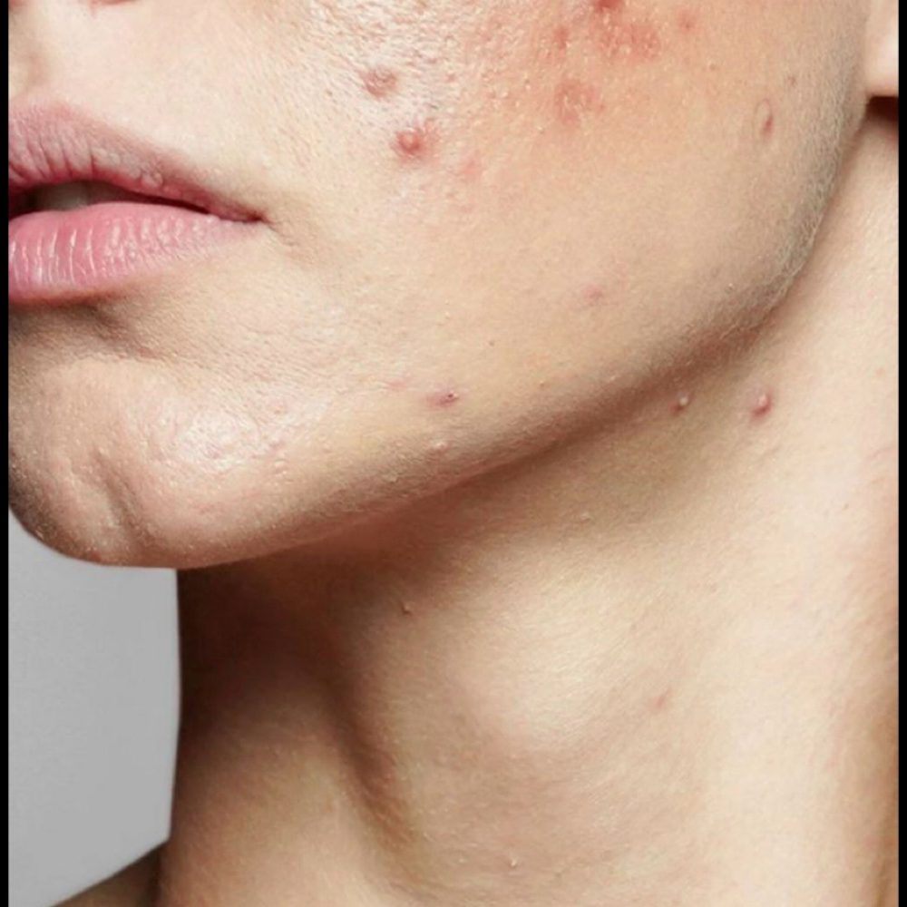 Facial Acne at Lizz S LashBeauty Studio in Philadelphia, PA