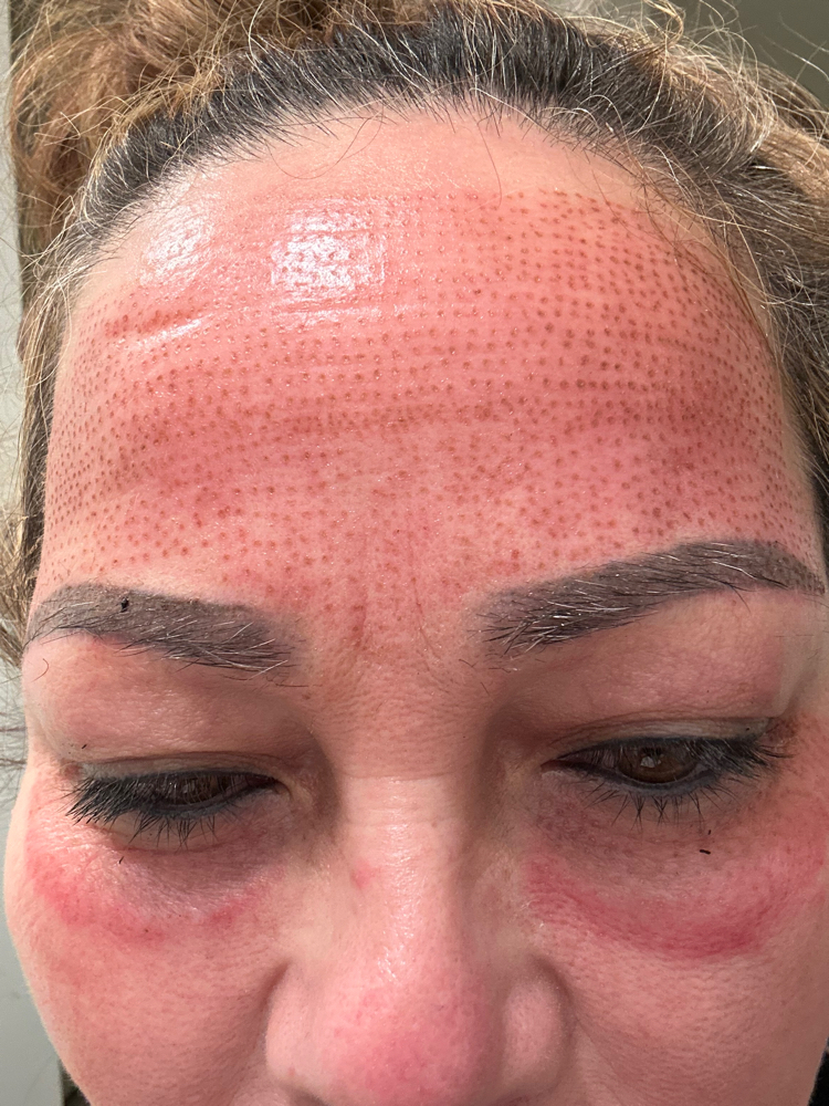 Fibroblast Skin Tightening
