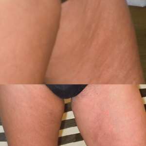 Cellulite Reduction