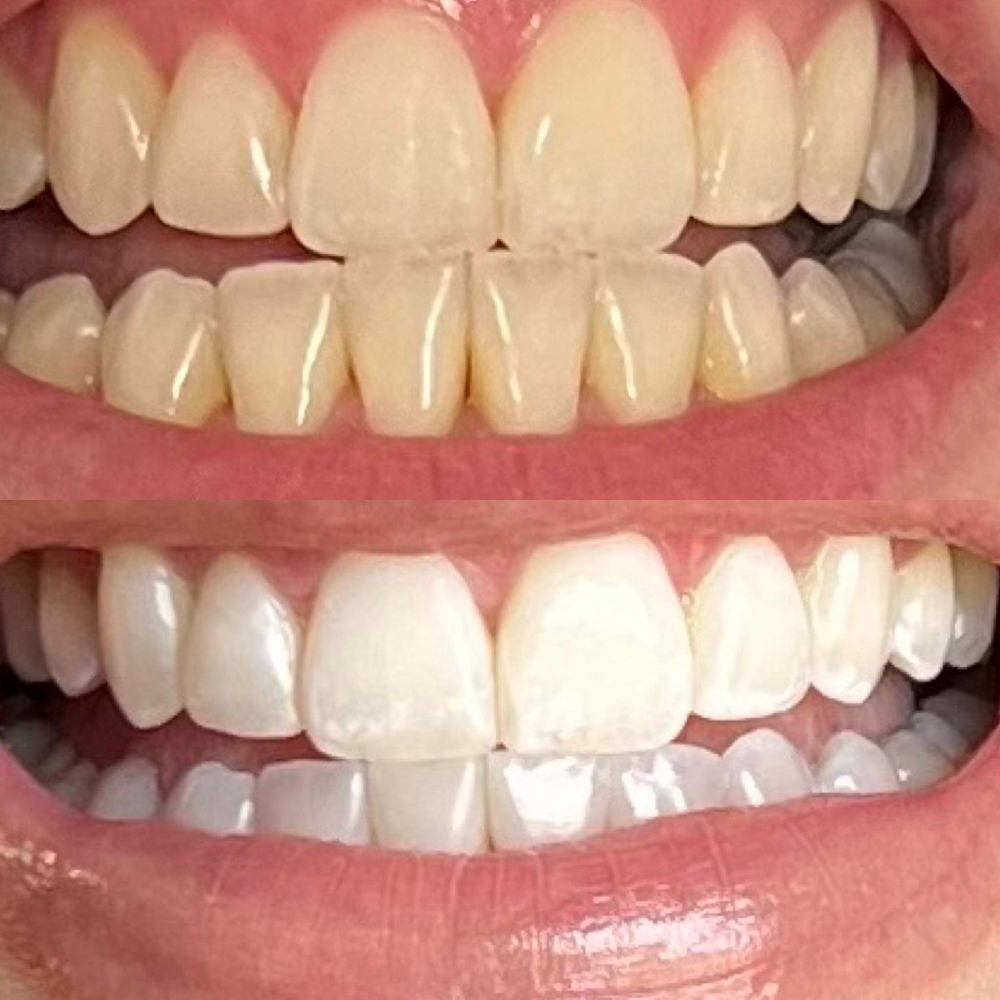 Deluxe Teeth Whitening Session