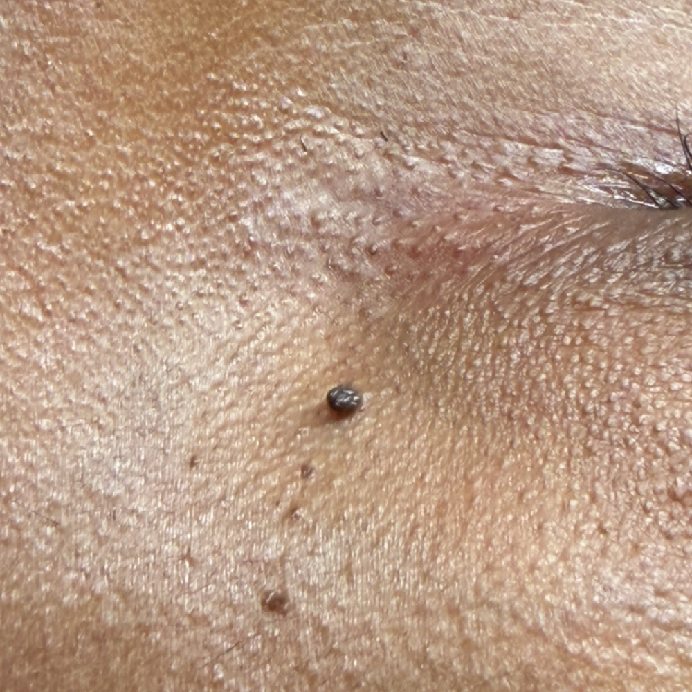 Consult - Skin Tag / DPN at ALL GLOWN UP SKINCARE in Temple Hills, MD