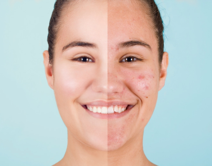 Acne Bootcamp Consult