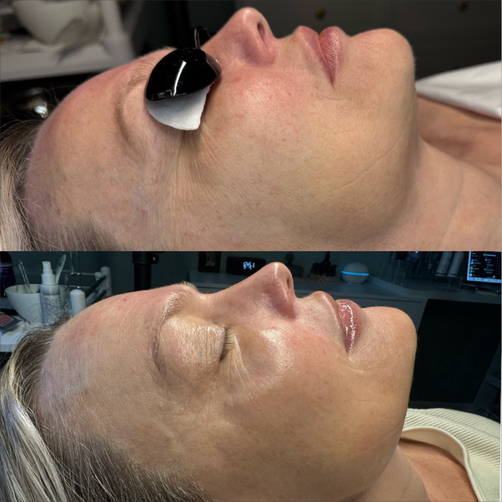 Dermaplaning Facial