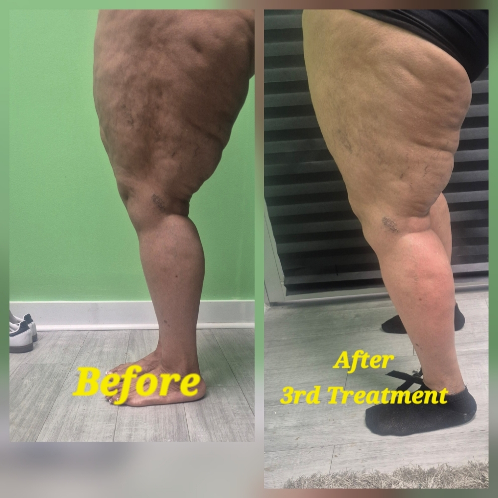 4 Leg 🔹 VARICOSE VEIN–SAFE LEG RED at JUST BEAUTIFUL SKIN in Goose Creek, SC