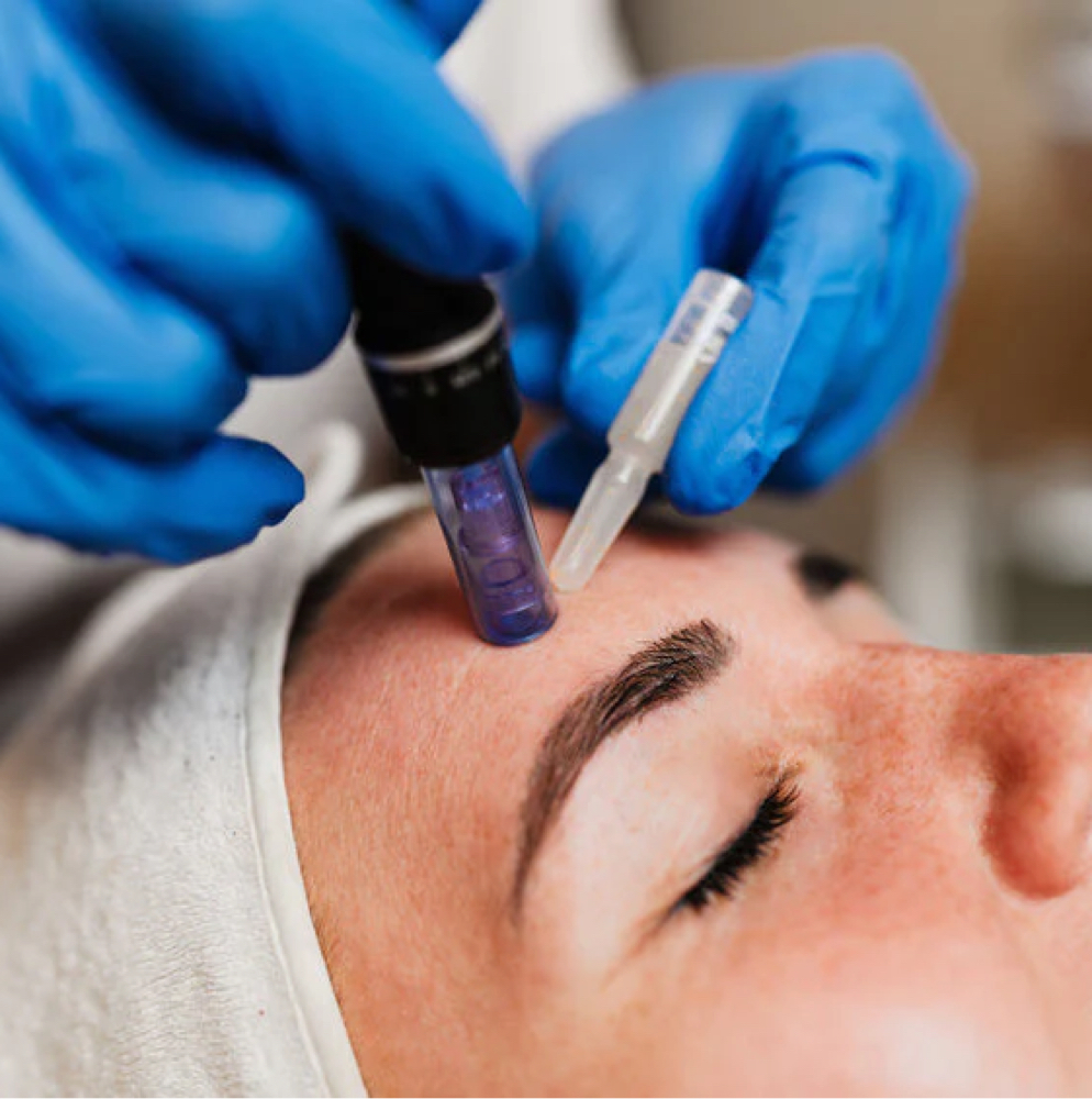 Microneedling