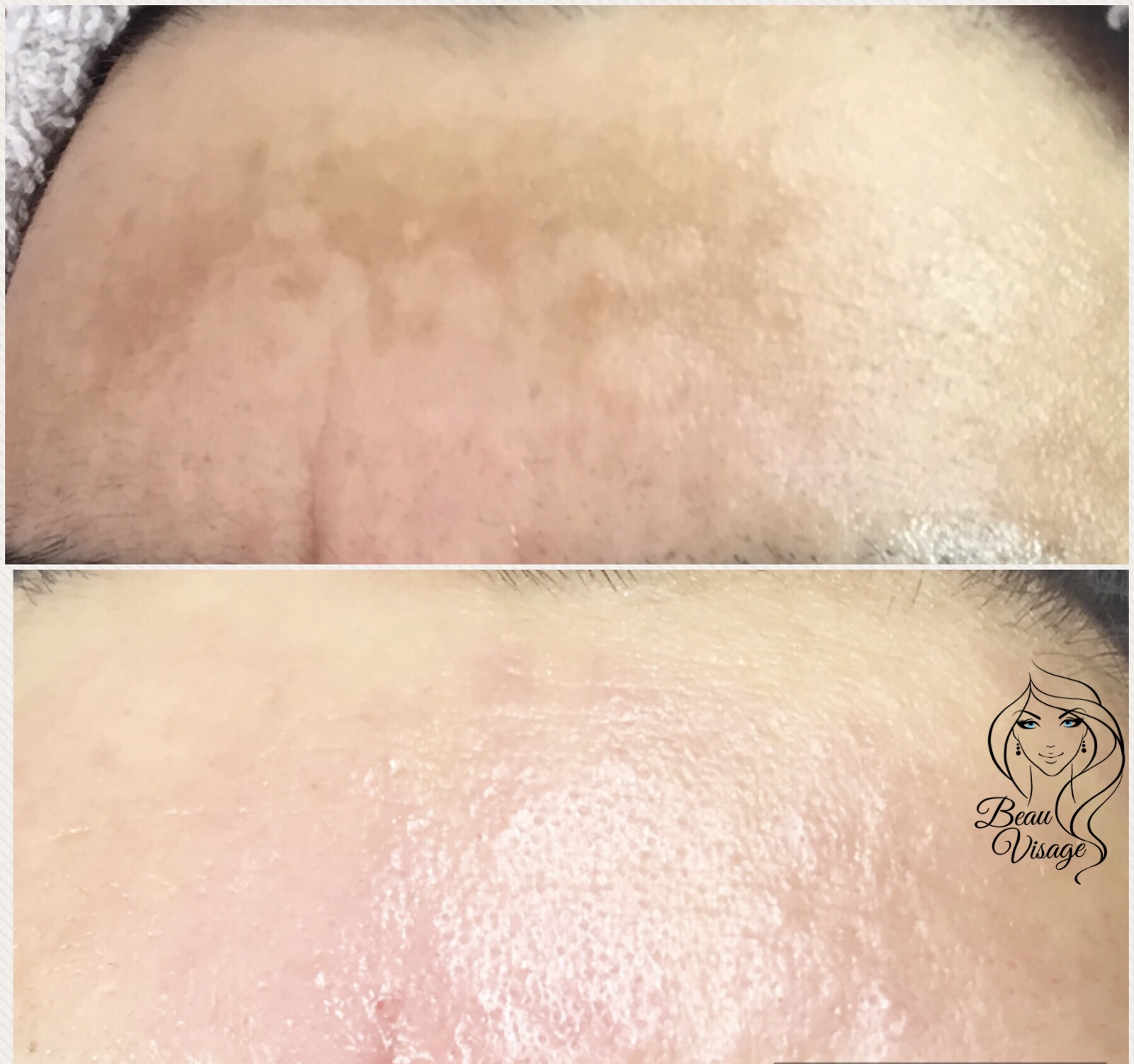 Chemical Peel