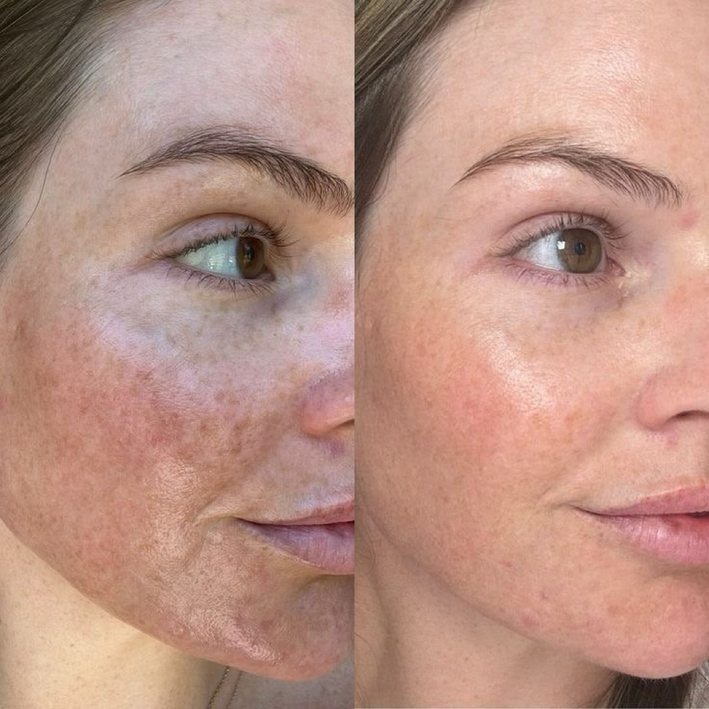 Hyperpigmentation Corrective Facial at Skin Deep Beauty Spa in Sulphur, LA