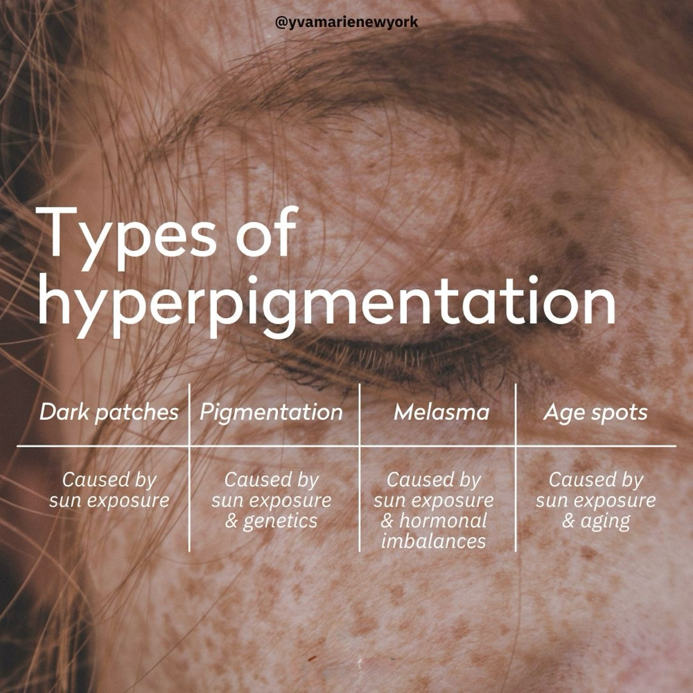Hyperpigmentation Facial at Skin Deep Beauty Spa in Sulphur, LA