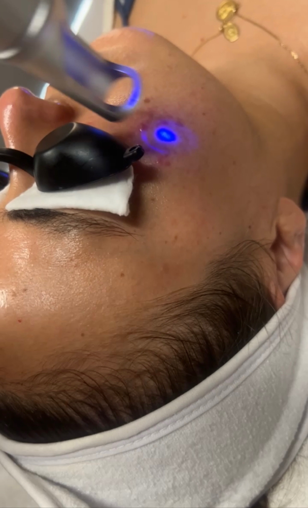 Pico Laser Treatment