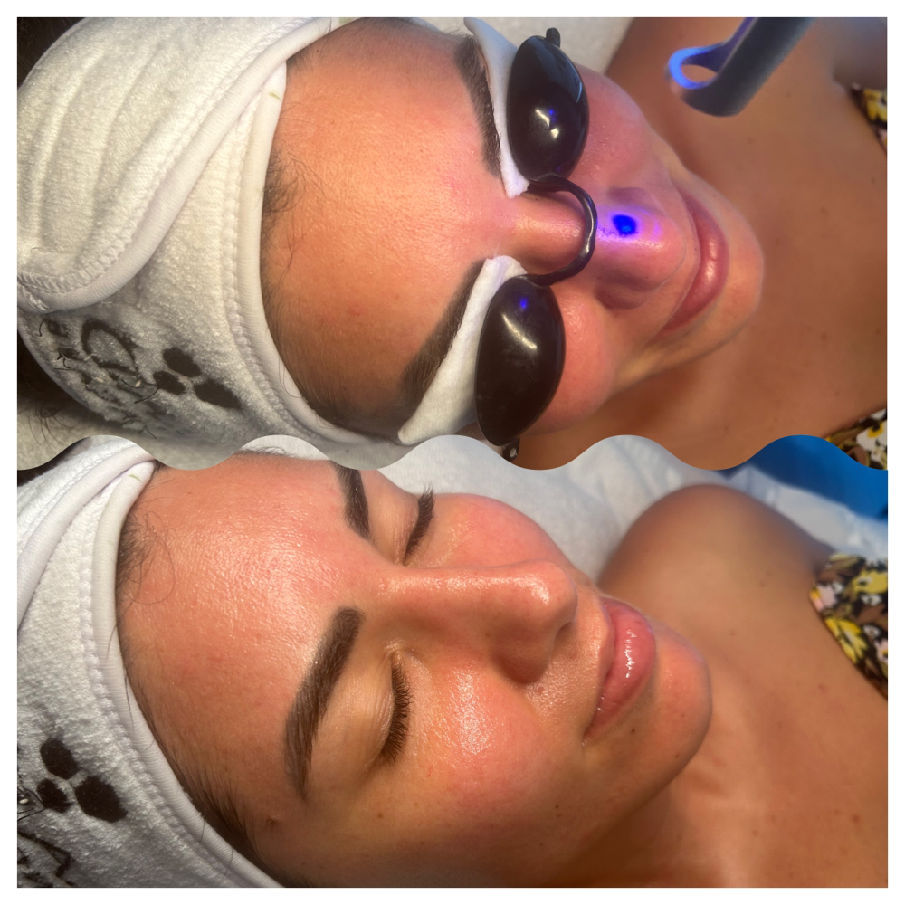Pico Laser Treatment
