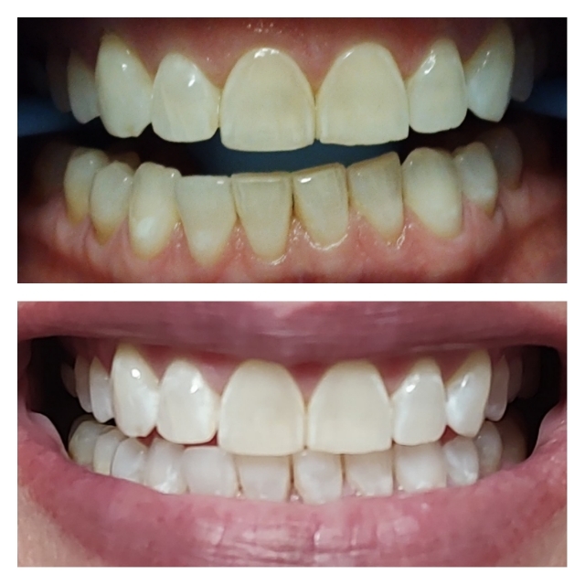 Express Whitening
