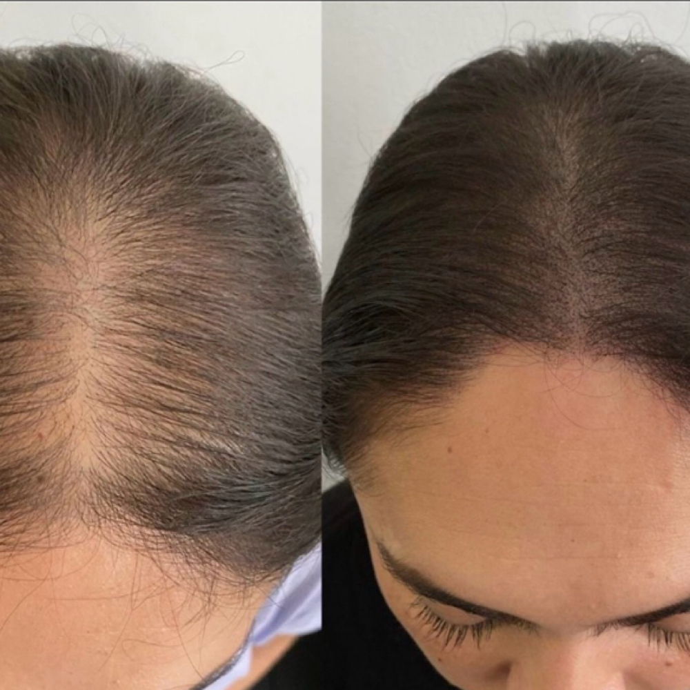 Scalp Micropigmentation SPM at SKIN CLINIC in Laguna Hills, CA