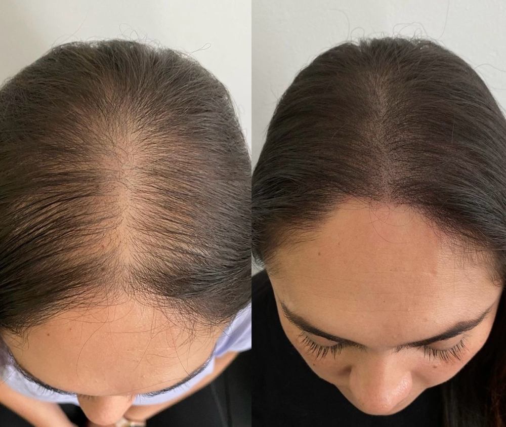 Scalp Micropigmentation SPM