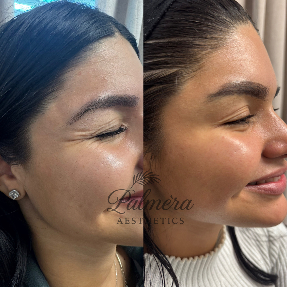 Neurotoxin Consultation at Palméra Aesthetics in Killeen, TX