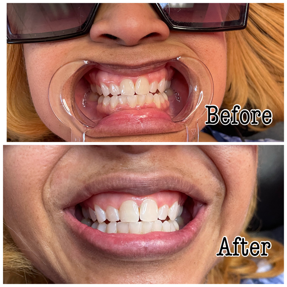 Teeth Whitening