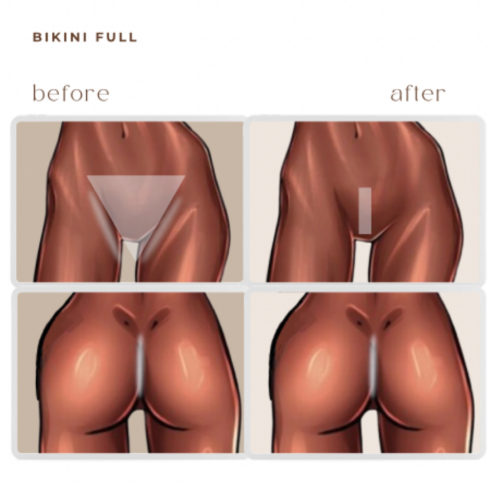 bikini full LASER HAIR REMOVAL at BEAUTY LAB COLLECTIVE in Miami, FL