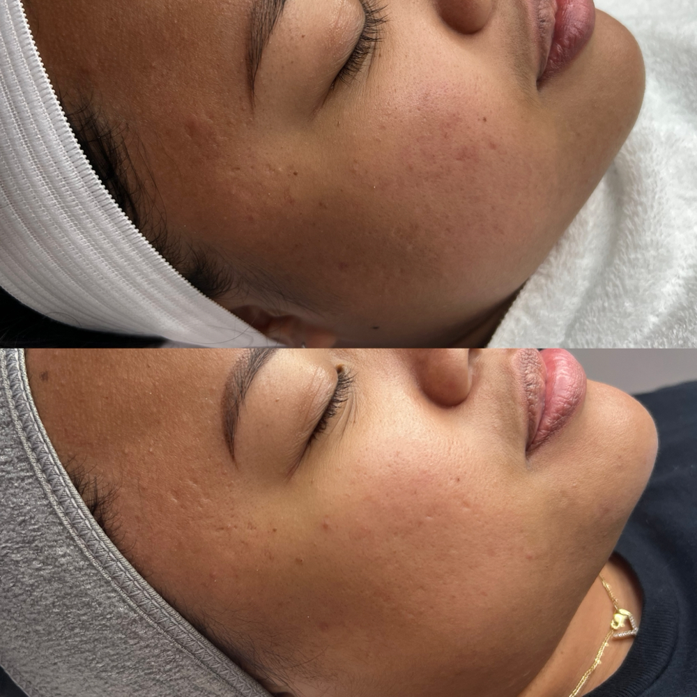 Microneedling Facial ๐