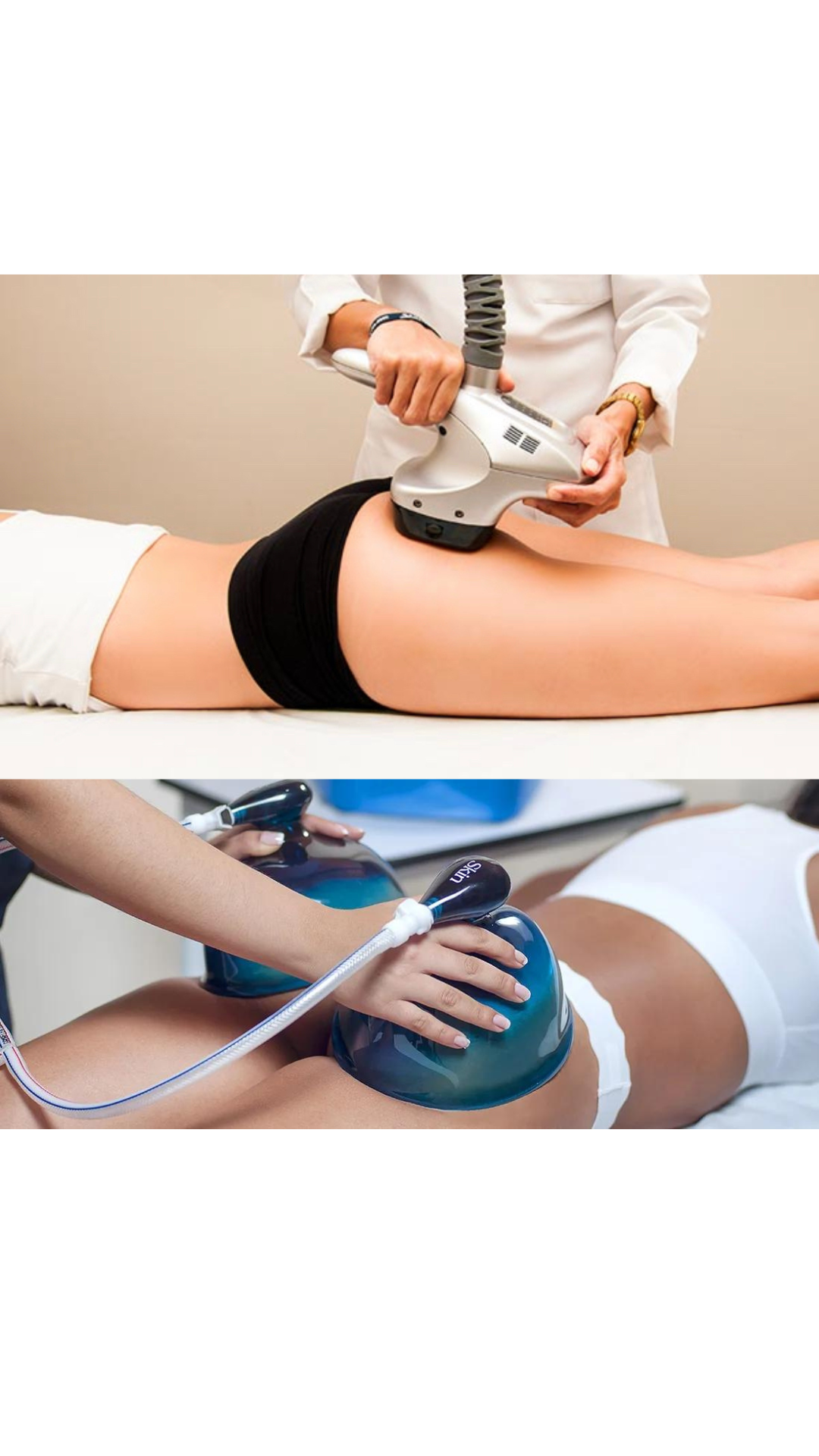 Cellulite Treatment 6 Sessions