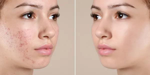 Collagen Induction Therapy