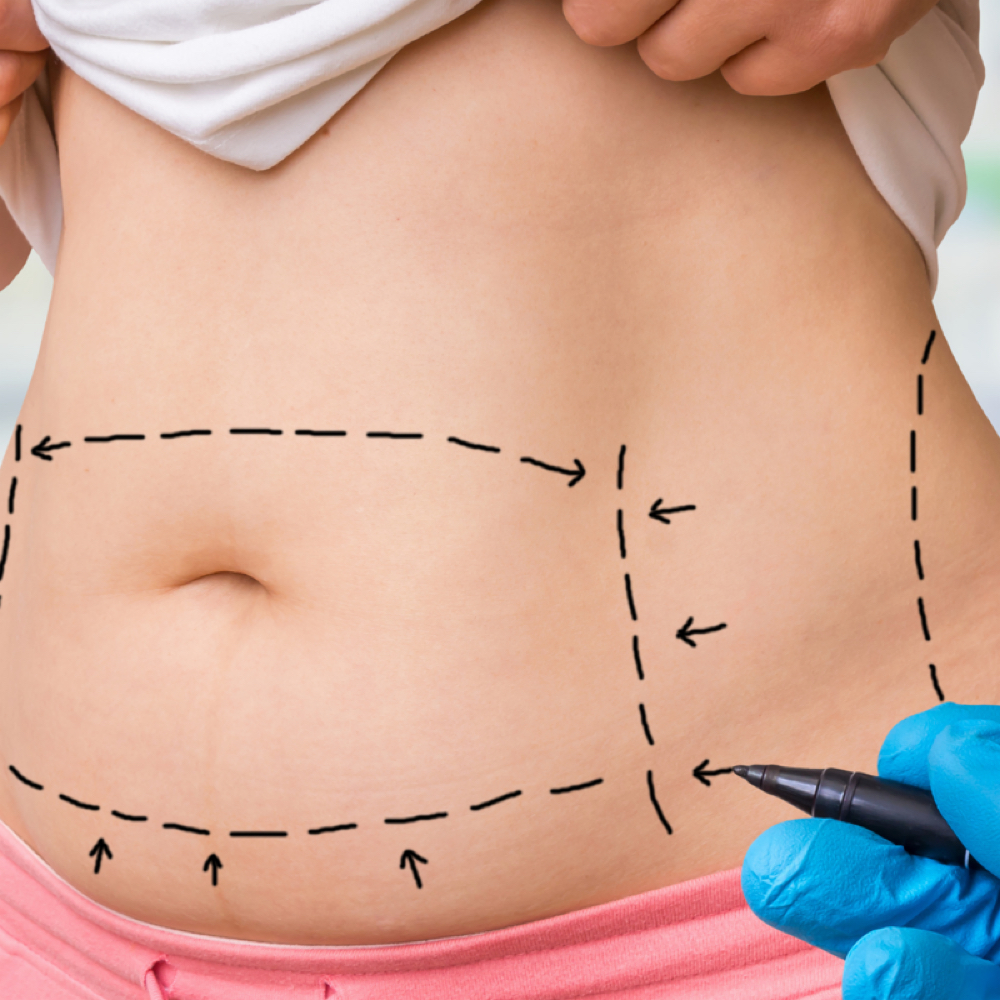 Post OP - Lymp Drainage 4 Sessions at Brazilian Body Sculpting in San Diego, CA