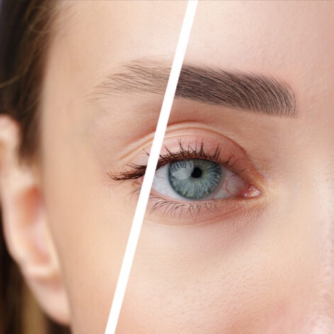 Saline Tattoo Removal at Sacred Order Beauty in Key Largo, FL